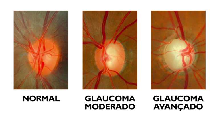 Glaucoma | IOA