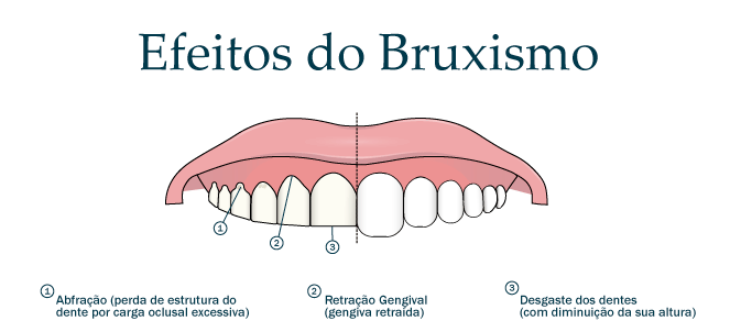 Bruxismo (ranger os dentes) - causas, sintomas, tratamento, cura